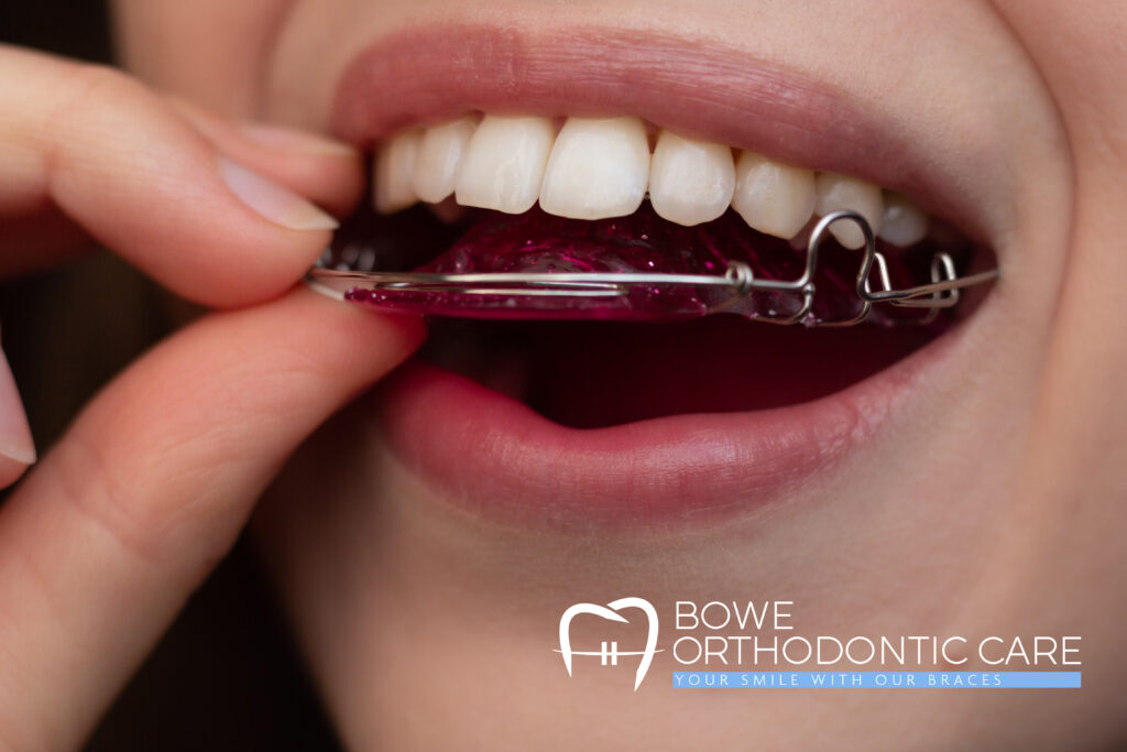 Why You Should Straighten Your Teeth: The Benefits of a Healthy, Confident Smile